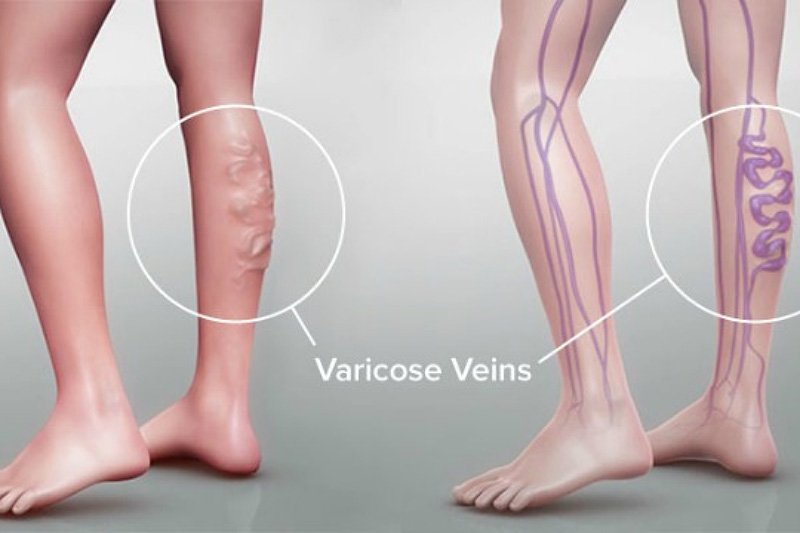 varis nedir