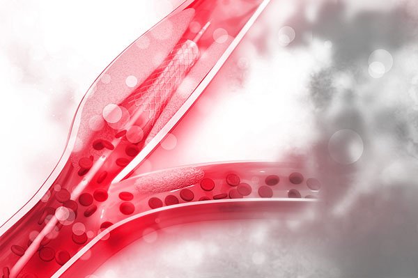 izmir varis tedavisi